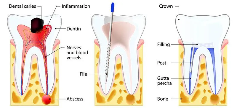 Removal of Broken File from Root Canal
