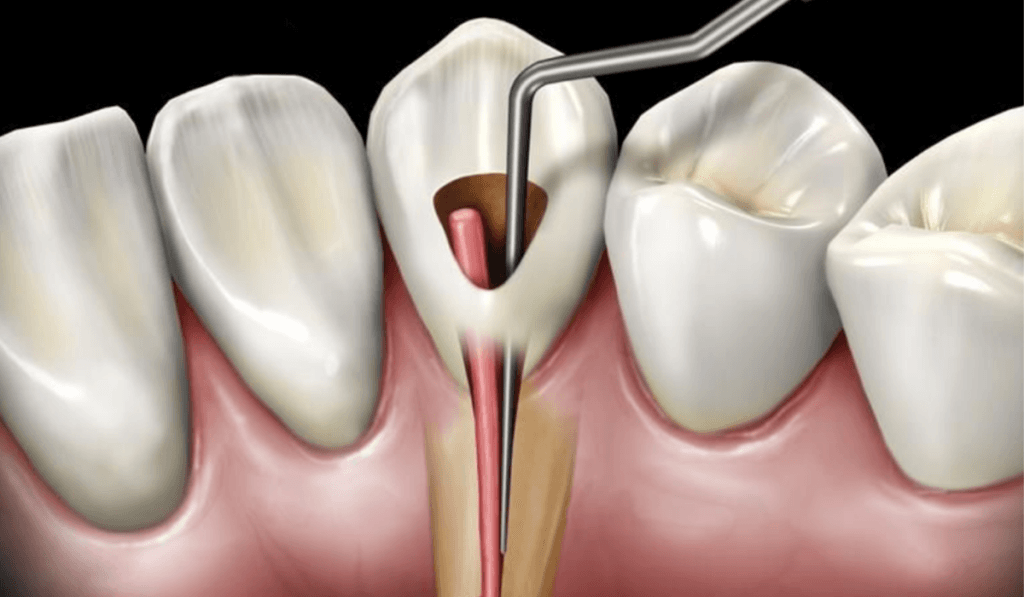 Re-Root Canal Treatment (Retreatment)