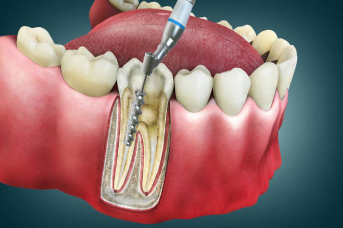Iatrogenic Errors in Root Canal Treatment